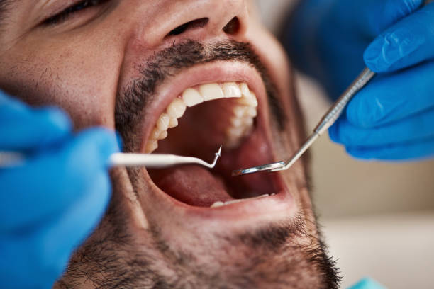 Best Emergency Treatment for Dental Infections or Abscesses in Fellsmere, FL