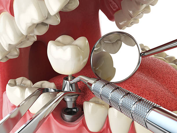 Best Emergency Denture Repair in Fellsmere, FL